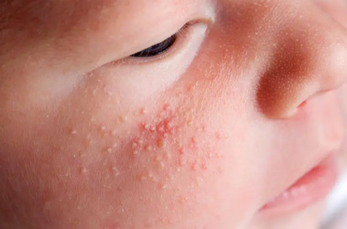 When White Spots on a Child’s Face Need Dermatological Attention